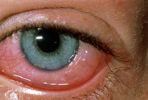 http://medicalpicturesinfo.com/wp-content/uploads/2011/10/Vernal-Conjunctivitis-6.jpg